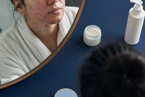 Illustration for How to Treat Hormonal Acne: Medical and Daily Skincare Options
