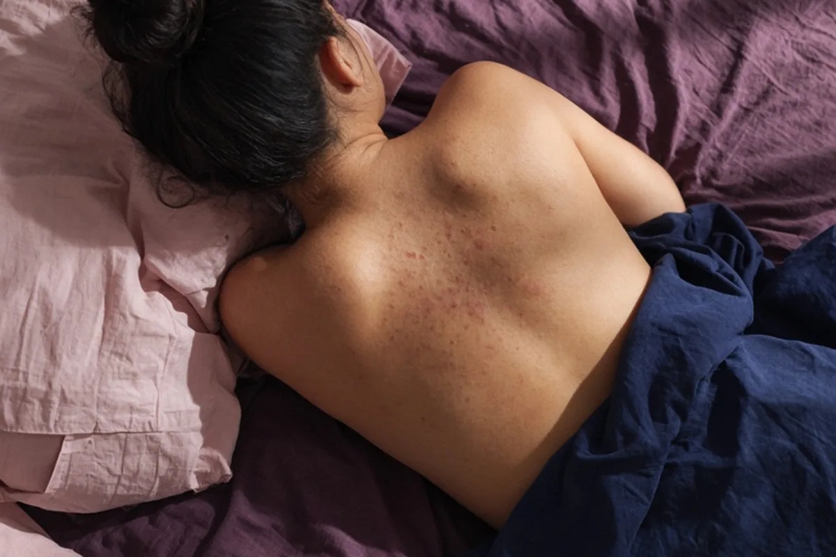 Illustration for Back Acne Treatment: A Practical Guide to Clearer Skin