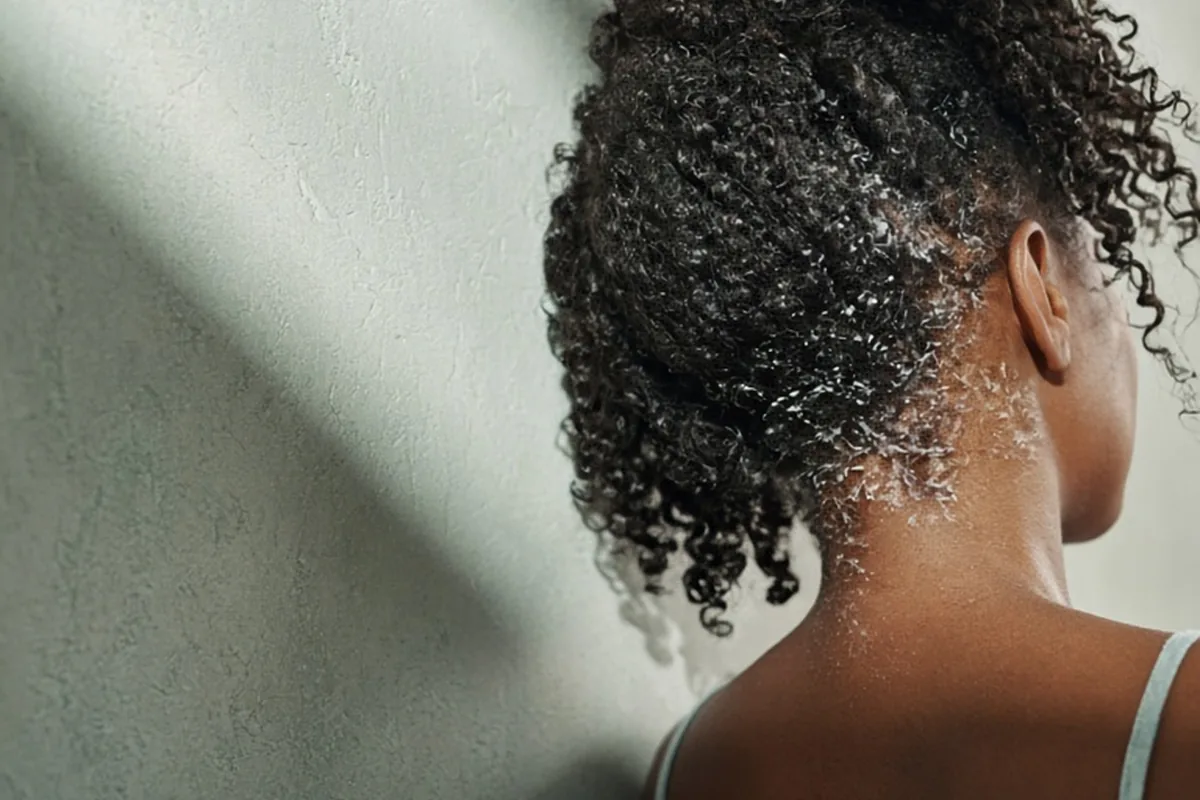 Illustration for Scalp Psoriasis Hair Care at Home vs. Salon: Safe Routines