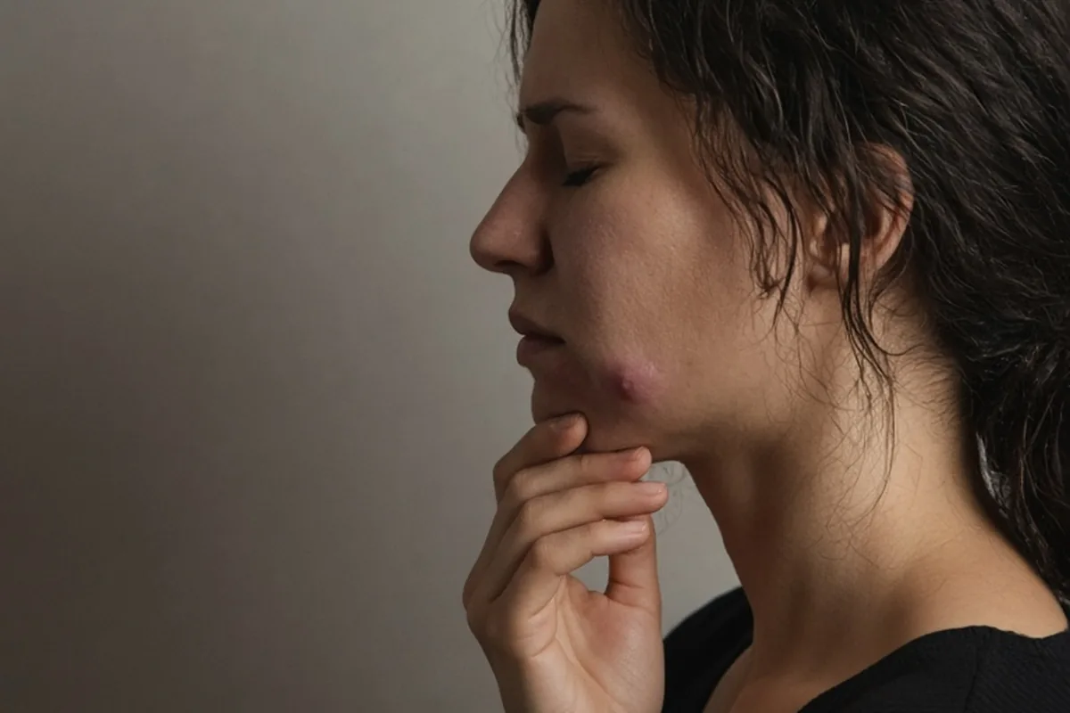 Illustration for Can a Tooth Infection Cause Cystic Acne? Spot the Link